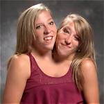 A Rare and Fascinating Conjoined Twin Condition