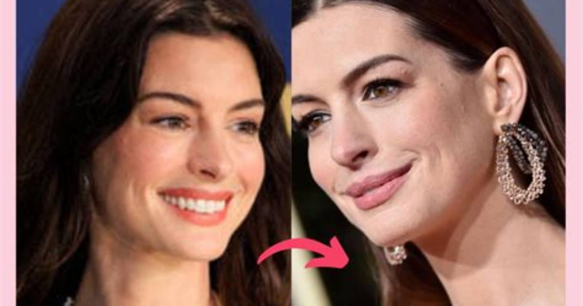 Anne Hathaways Plastic Surgery in 2 Rhinoplasty, Boob Job, & Botox Injection Rumors Examined!