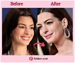 Anne Hathaways Plastic Surgery in 2 Rhinoplasty, Boob Job, & Botox Injection Rumors Examined!