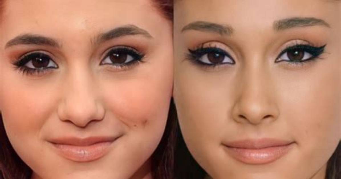 Ariana Grande's Eye Surgery and Its Profound Implications