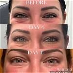 Botox Jelly Roll