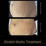 Celebrating Beauty: Bbw with Stretch Marks