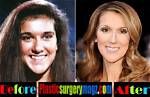 Celine Dion Nose Job Plastic Surgery Before and After |