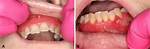 Diffuse Mildly Erythematous Mucosa Unraveled