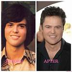 Donny Osmond's Plastic Surgery Journey Revealed