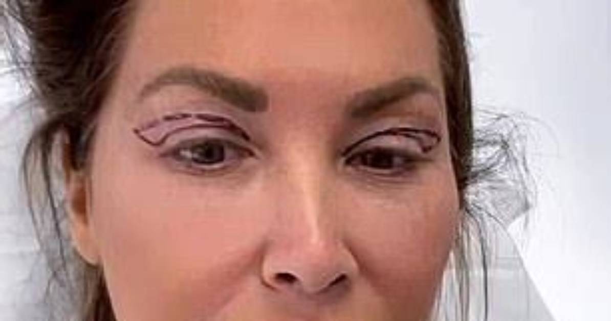 Emily Simpson Eye Surgery: Recovery, Results, and More