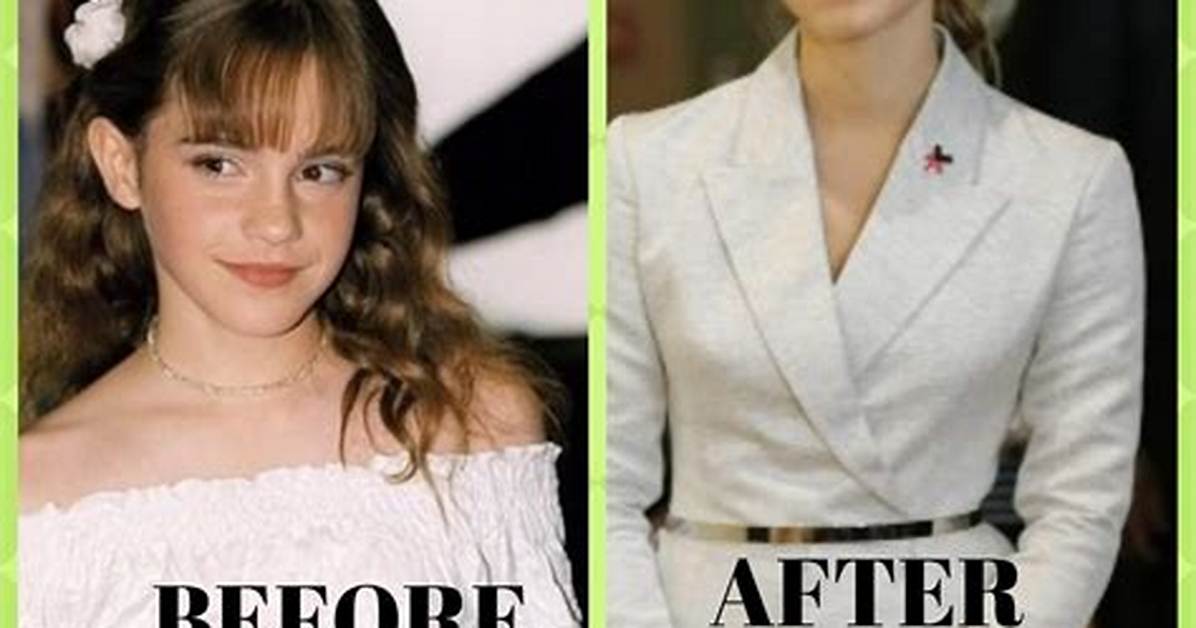 Emma Watson Surgery: Uncovering Unrevealed Truths