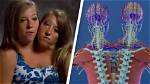 Exploring the Fascinating Anatomy of Conjoined Twins Abby and Brittany
