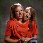 Exploring the Lives and Legacy of Abby and Brittany Conjoined Twins