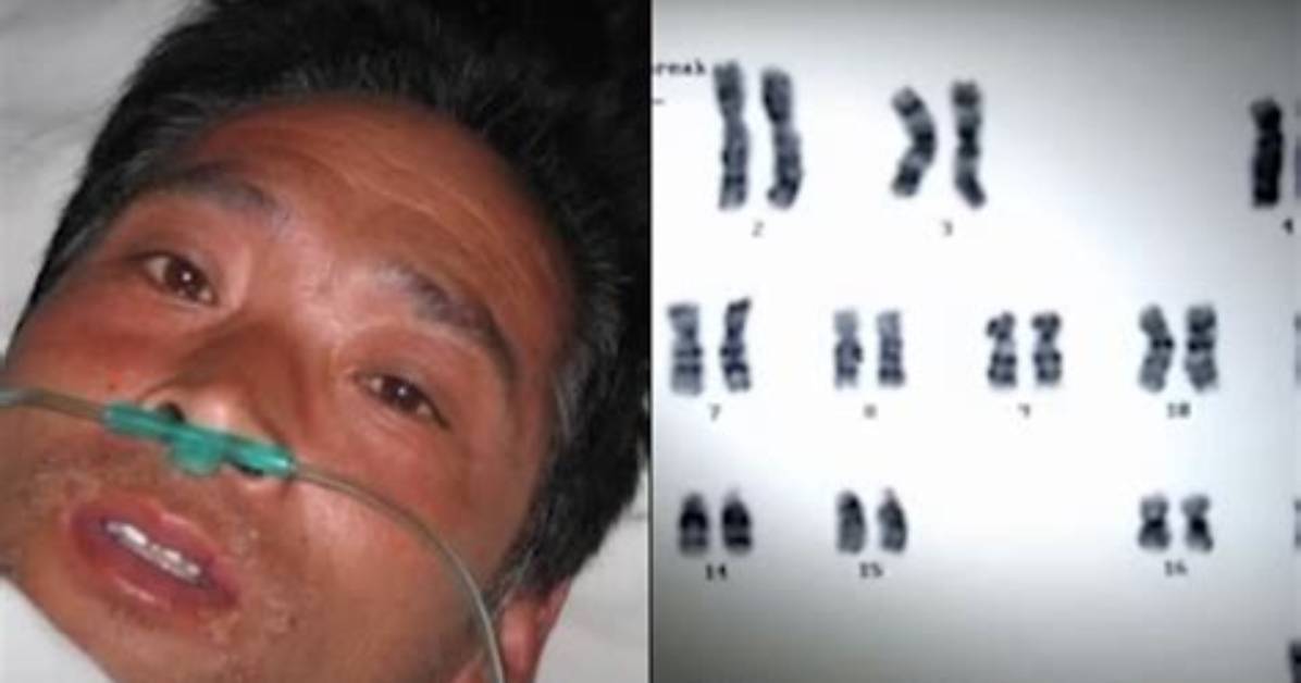 Hisashi Ouchi Real Photos, Suffered 83 Days of Death from Radiation Poisoning