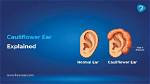 How to Avoid Cauliflower Ear: Prevention Tips and Techniques
