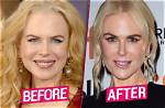 Is Nicole Kidman's Plastic Surgery a Good or Bad Thing?