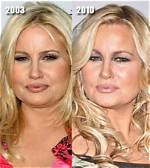 Jennifer Coolidge Botox and Lip Filler Before and After Photos, Beauty Secret Explored!