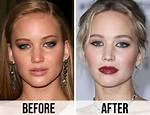 Jennifer Lawrences Plastic Surgery: Rumors and Reality