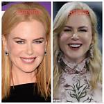 Nicole Kidman and Botox: the Truth Behind Her Ageless Beauty