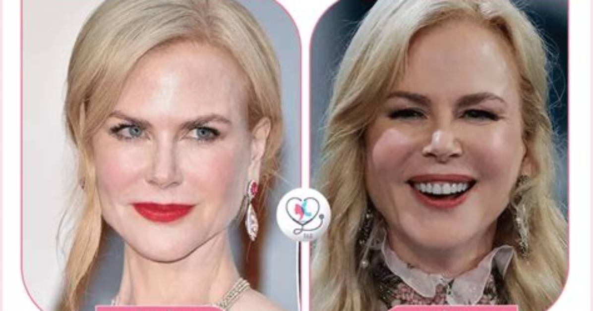 Nicole Kidman Facelift: a Comprehensive Look at Her Transformation and Impact on the Beauty Industry