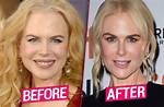 Nicole Kidman: the Facelift Journey of a Hollywood Icon