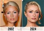 Paris Hiltons Transformation: Before and After Rhinoplasty