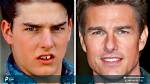 Tom Cruise Before and After Veneers