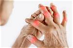 Understanding Matthew Perry Fingers: Causes, Symptoms, and Treatment