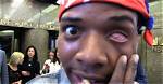 Unveiling the Enigma: Fetty Wap's Eye Injury