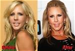 Vicki Gunvalson's Plastic Surgery Journey Revealed