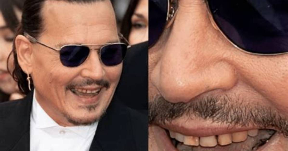 What Happened to Johnny Depps Teeth? |