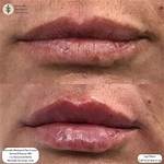 When Beauty Goes Wrong: Understanding Botched Fillers