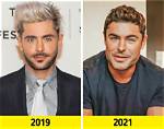 Zac Efron's Shocking Face Accident: Before and After